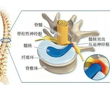 椎間盤突出