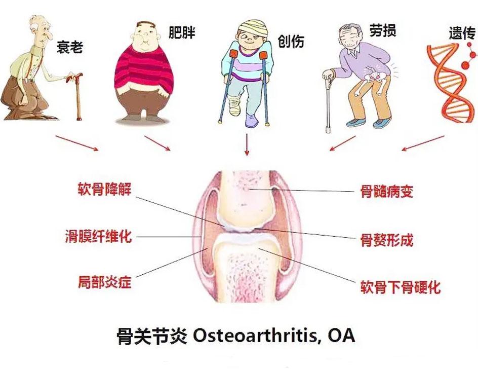 關節炎