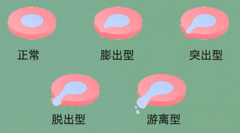 椎間盤突出四階段 椎間盤突出四階段