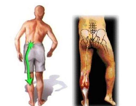 下肢放射痛 下肢放射痛
