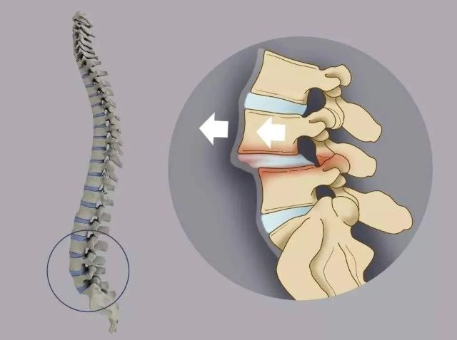 腰椎滑脫示意圖 腰椎滑脫示意圖