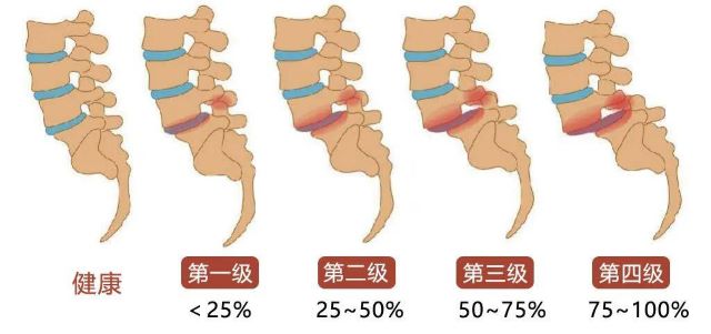 腰椎滑脫分級(jí) 腰椎滑脫分級(jí)