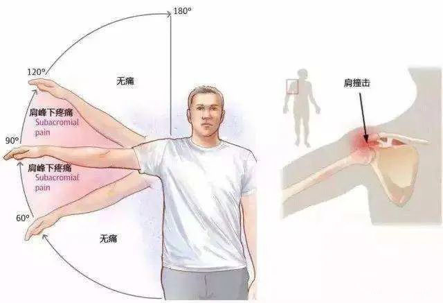肩關節活動受限 肩關節活動受限