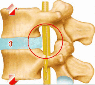 腰椎間盤突出癥 腰椎間盤突出癥