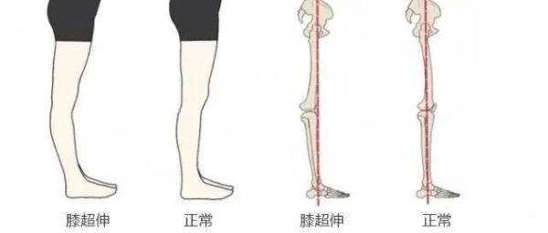 膝超伸對比圖 膝超伸對比圖