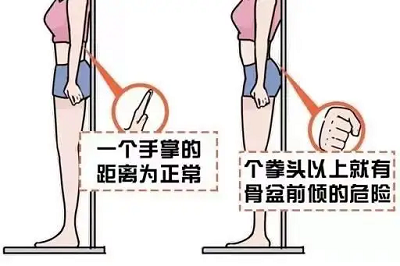 骨盆前傾自測 骨盆前傾自測