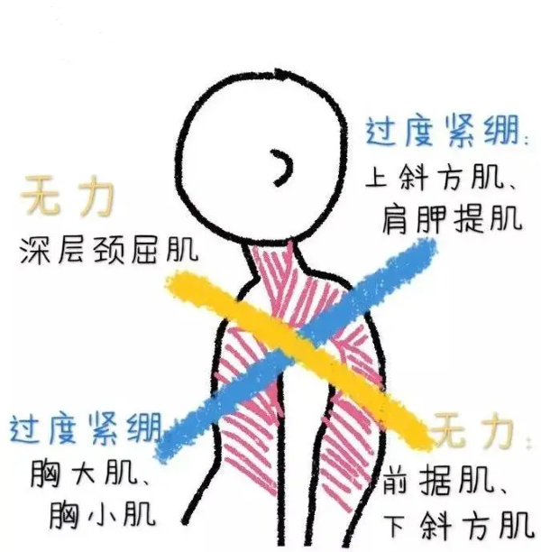 上交叉綜合征 上交叉綜合征