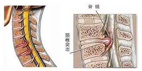 頸椎突出 頸椎突出