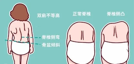脊柱側彎 脊柱側彎