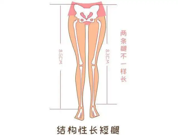 結構性長短腿