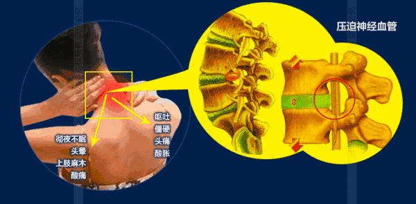 壓迫神經(jīng)血管 壓迫神經(jīng)血管