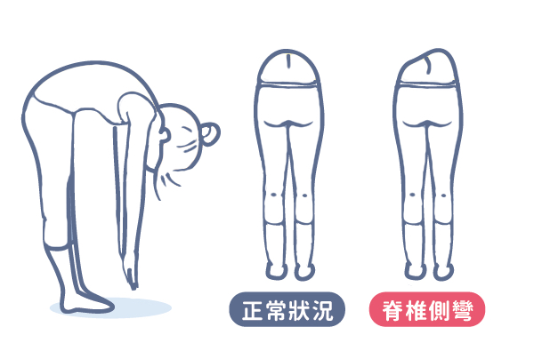 脊柱側彎自測 脊柱側彎自測