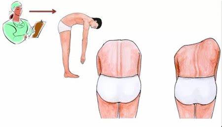 脊柱側彎自測 脊柱側彎自測