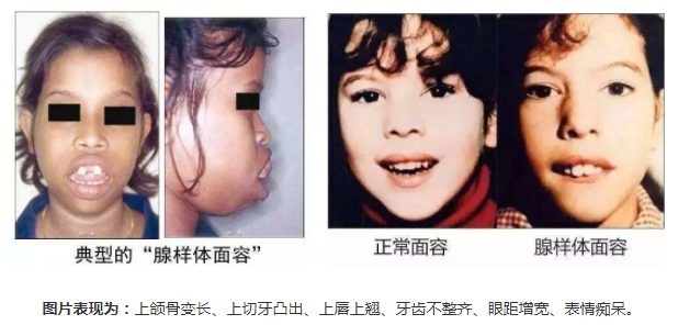 正常面容與腺樣體面容圖片對比圖 正常面容與腺樣體面容圖片對比圖