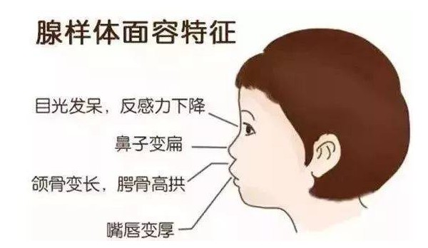 腺樣體面容特征 腺樣體面容特征