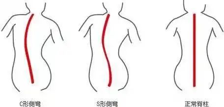 脊柱側彎 脊柱側彎