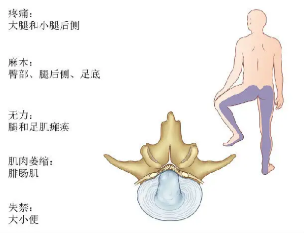 腰椎間盤突出癥狀