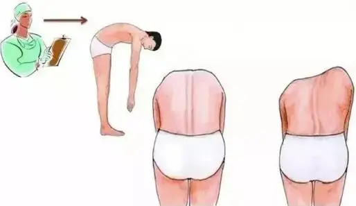 脊柱側彎篩查 脊柱側彎篩查