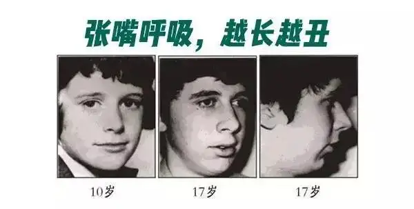 腺樣體面容 腺樣體面容