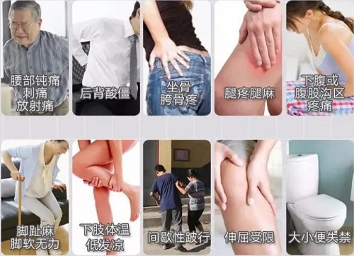 腰突癥狀 腰突癥狀