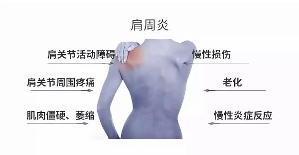 肩周炎癥狀 肩周炎癥狀
