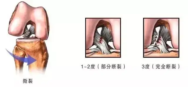 韌帶損傷 韌帶損傷