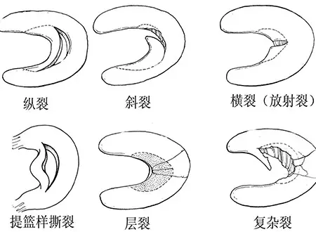 半月板損傷 半月板損傷