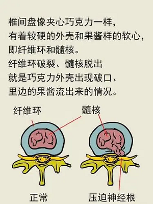 腰椎間盤突出 腰椎間盤突出