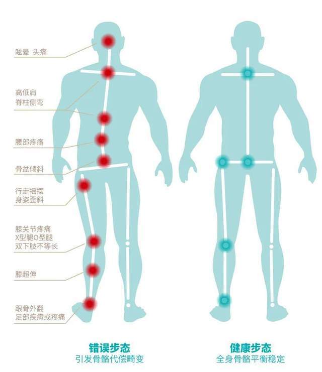 錯(cuò)誤步態(tài)骨骼代償畸變