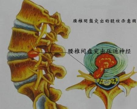 髓核壓迫神經(jīng) 髓核壓迫神經(jīng)