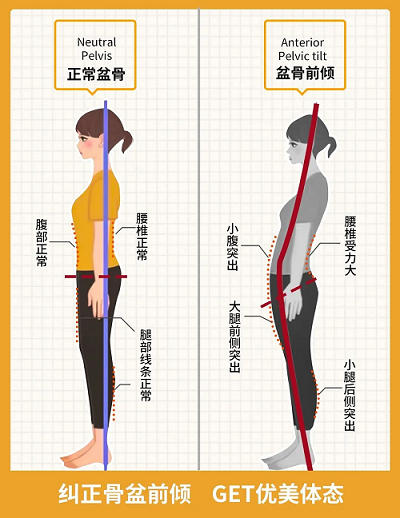 糾正骨盆前傾 糾正骨盆前傾