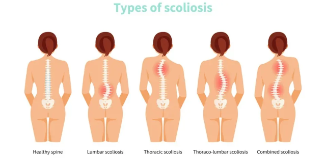 脊柱側彎 脊柱側彎