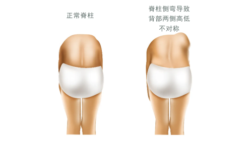 脊柱側彎對比圖 脊柱側彎對比圖