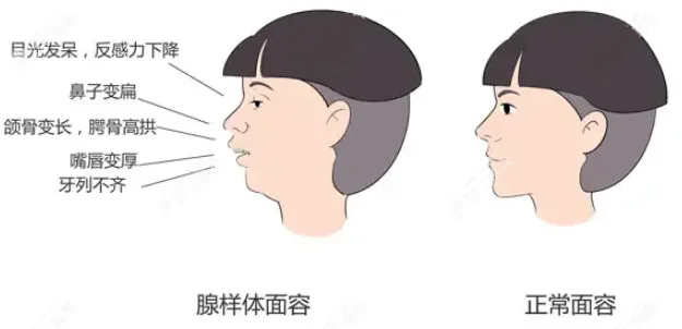 腺樣體面容 腺樣體面容