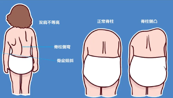 脊柱側彎體征 脊柱側彎體征