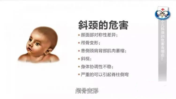 斜頸危害 斜頸危害