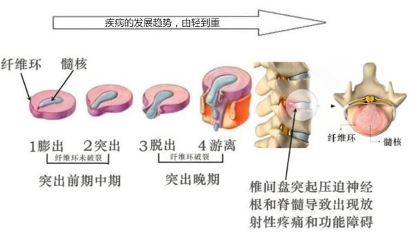 椎間盤突出疾病發(fā)展
