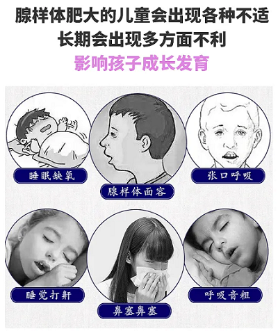 腺樣體肥大癥狀