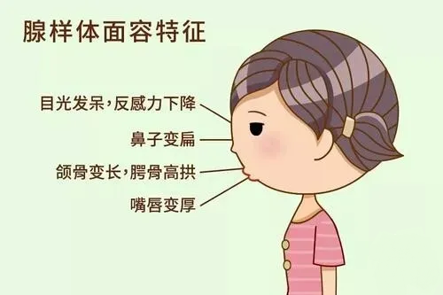 腺樣體面容特征 腺樣體面容特征