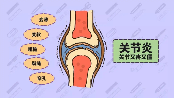關節炎癥狀 關節炎癥狀