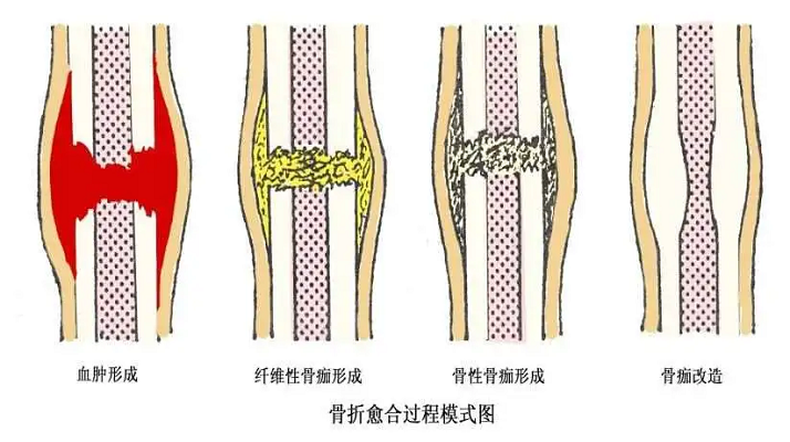 骨折愈合 骨折愈合